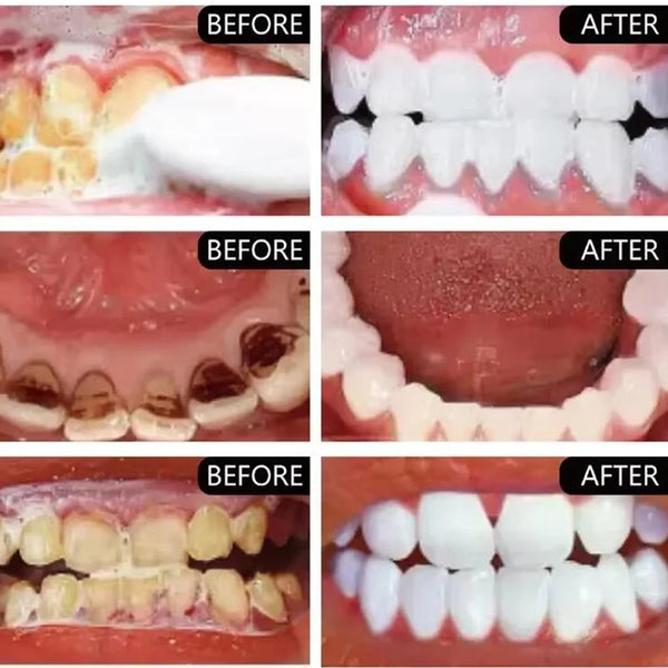 5-Day Teeth Whitening Powder - Removes Plaque, Stains & Calculus for Fresh Breath