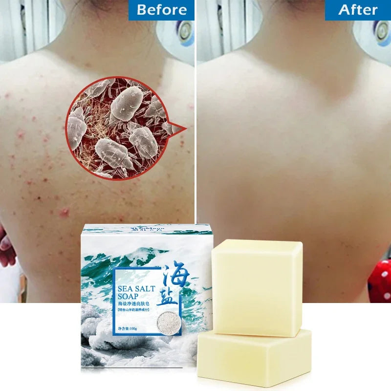 Sea Salt Whitening & Moisturizing Soap - Pore Cleansing, Acne & Pimple Treatment Bar