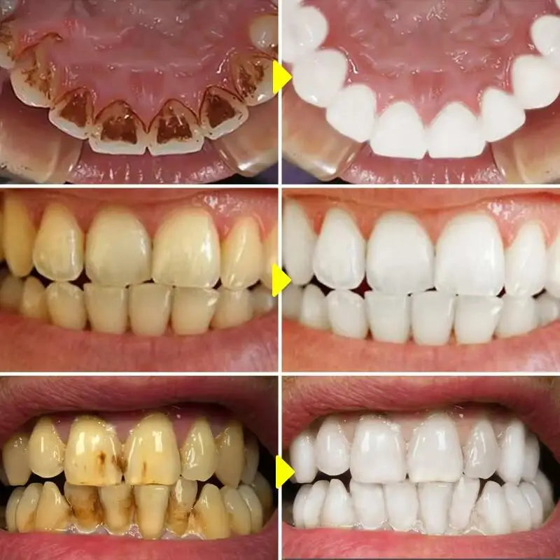 5-Day Teeth Whitening Powder - Removes Plaque, Stains & Calculus for Fresh Breath