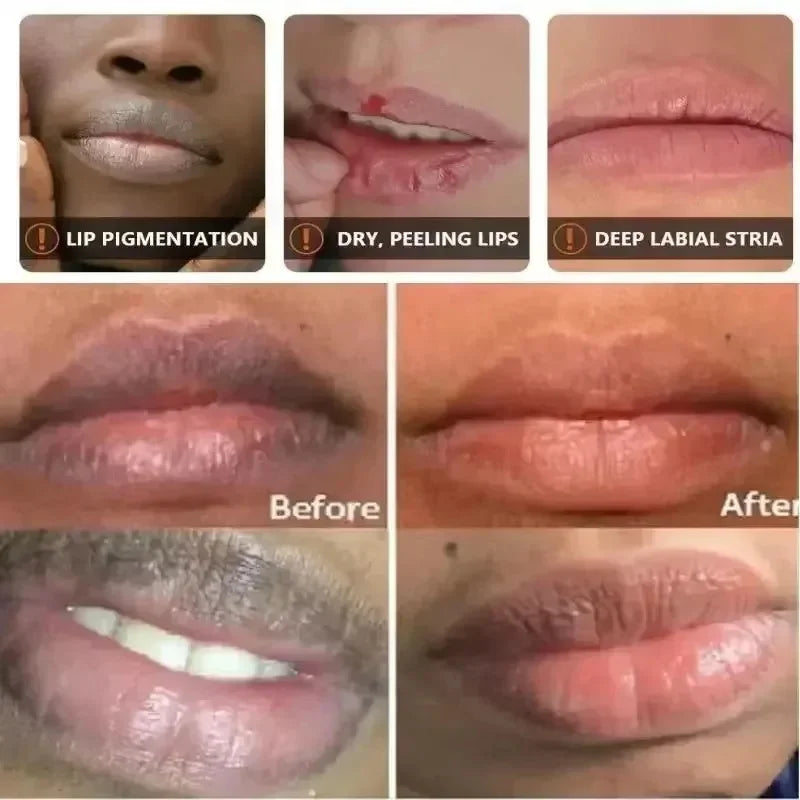 Dark Lip Lightening Balm & Melanin Mask - Exfoliating Pink Treatment for Lip Lines