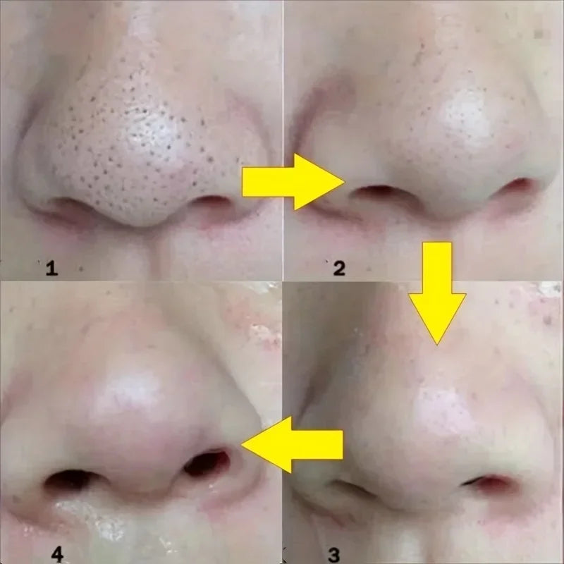 Tanyi 15-Piece Blackhead Nose Strips - Deep Cleansing Nasal Pore & Acne Removal